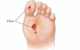 Caring for the Diabetic Foot Ulcer