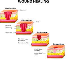 Healing Signs: How to Recognize if Your Wound is Healing Properly